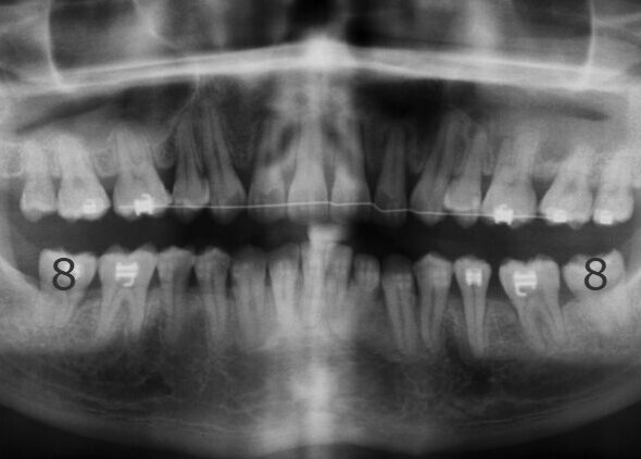 002063NDHN Panoramic dental X-ray of both jaws showing teeth with fillings and a wire across the lower front teeth (orthodontic appliance).