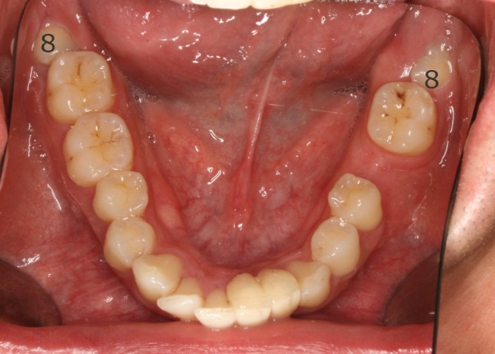 002063PQKK Close-up view of the lower dental arch showing premolars and molars with minor staining, smooth occlusal surfaces, and pink gums; saliva present in the mouth.