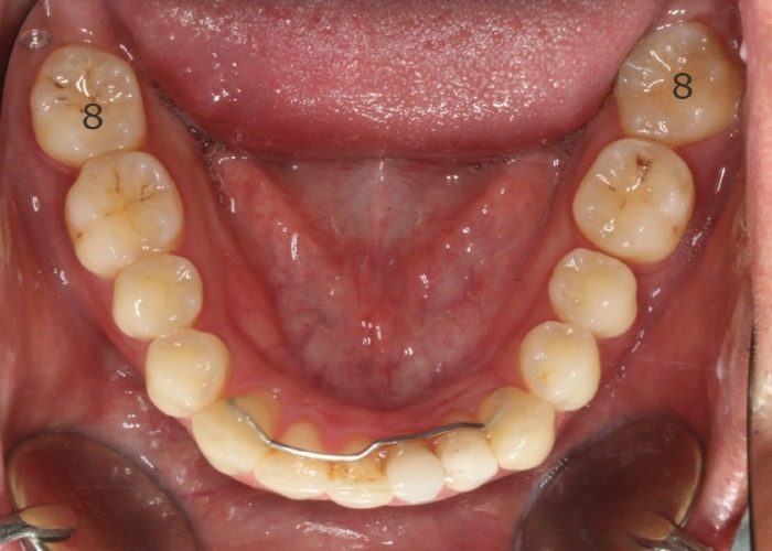 002063Q8U8 Close-up view of the lower dental arch with a lingual orthodontic wire in place and visible molars/tooth surfaces showing some staining. The gums and tongue are visible around the arch.