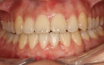 0021256M9B Close-up of an open mouth showing upper and lower front teeth with red, inflamed gums along the gumline.