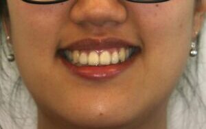 002125O7FF Young woman with black glasses smiling, wearing a red top; a small brown mark on her forehead is visible in a neutral background.