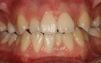 002125X8RQ Upper front teeth with crowding and red, inflamed gum tissue above the teeth.
