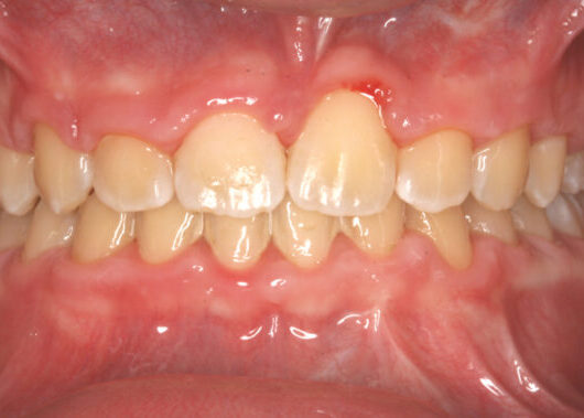 Anterior Occlusion-Final-2012_03_22-0_1 Front teeth show crowding and overlapping with mild gingival inflammation (gum redness) around the anterior teeth in a full smile view of both arches.