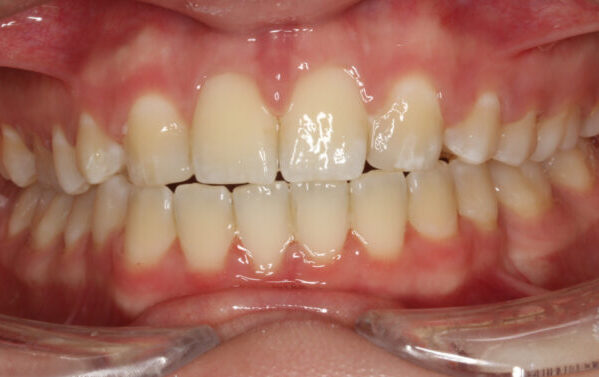 Anterior Occlusion-Final-2022_12_06-0_5 Close-up of a crowded, misaligned bite with overlapping front teeth and pink, slightly inflamed-looking gums.