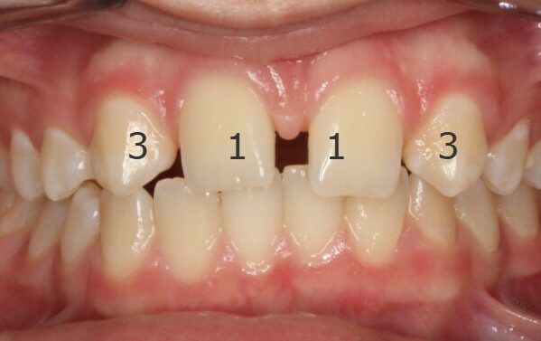 Anterior Occlusion-Initial-2020_02_14-0_4 Close-up of an open mouth showing missing upper central incisors with crowding of the surrounding teeth and pink gums behind.