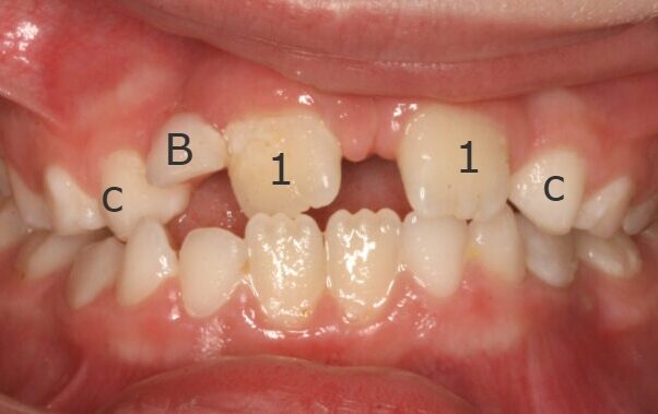 Anterior Occlusion-Observation-2014_07_17-0_1 Close-up of mouth showing a missing upper front tooth and crowded, crooked teeth in the upper and lower arches.