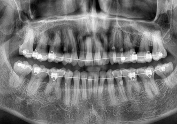 DropFile102238 Panoramic dental X-ray showing upper and lower teeth with braces and an orthodontic archwire across both arches
