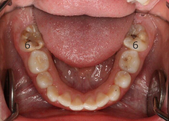 DropFile47825 Close-up of an open mouth showing the lower dental arch; tongue rests on the floor of mouth, with molars showing decay and fillings; orthodontic retractors visible on sides.