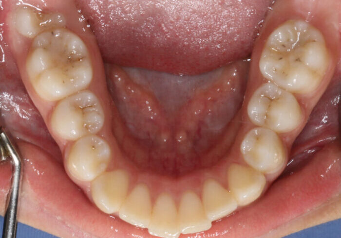Lower Occlusal-Initial-2025_02_04-0_2 Inside view of the lower teeth with a dental mirror visible on the left; occlusal surfaces show mild staining and wear on molars and premolars.