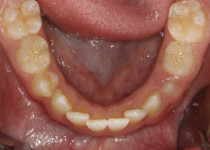 Lower Occlusal-Observation-2020_06_04-0_2 Close-up of the lower dental arch showing mild crowding and yellowish molars and incisors.