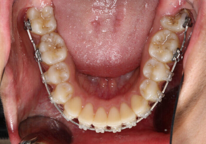 Lower Occlusal-Progress-2026_08_05-0_4 Intraoral view of upper and lower teeth with metal braces; visible plaque and staining on molars.