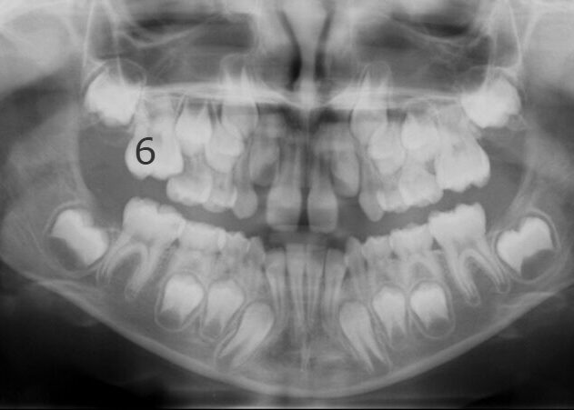 Panoramic-Initial-2007_07_06-1_1 Panoramic dental X-ray showing mixed dentition with developing permanent teeth and mild crowding in the lower jaw.