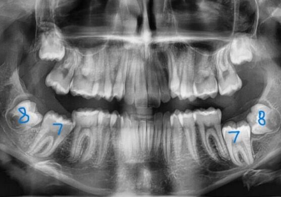 Panoramic-Initial-2024_07_18-0_1 Panoramic dental X-ray of upper and lower jaws with teeth 7 and 8 labeled near the molar regions, showing developing wisdom teeth on both sides.