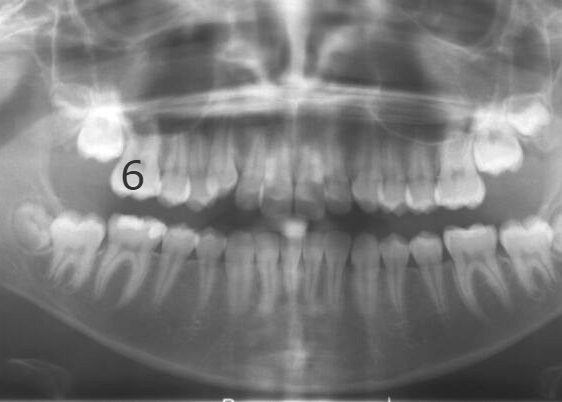 Panoramic-Observation-2011_06_30-0_5 Panoramic dental X-ray showing upper and lower teeth and jaw bones in a single image