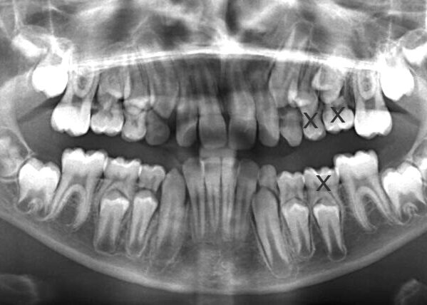 Panoramic-Observation-2019_06_04-0_3 Panoramic radiograph of the jaws showing both arches and all teeth, including developing molars and surrounding bone anatomy.