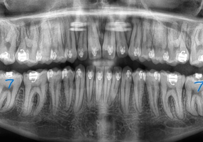 Panoramic-Progress-2026_08_05-0_3 Panoramic dental X-ray showing highlighted lower second molars on both sides with blue 7 marks.