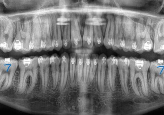 Panoramic-Progress-2026_08_05-0_3 Panoramic dental X-ray showing highlighted lower second molars on both sides with blue 7 marks.
