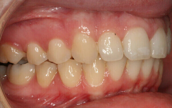 Right Occlusion-Final-2010_09_30-0_2 Close-up of upper and lower teeth with mild crowding and red inflamed gums; a small dark spot is visible on the gum between front teeth.