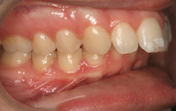 Right Occlusion-Initial-2009_05_08-1_1 Close-up side view of chewing surfaces showing upper and lower teeth with mild crowding and pink gums; a dental cheek retracter is in place.