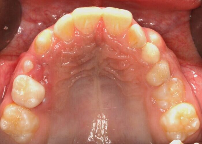 Upper Occlusal-Observation-2020_06_04-0_1 Upper dental arch showing crowded front teeth and inflamed gum tissue around the palate area
