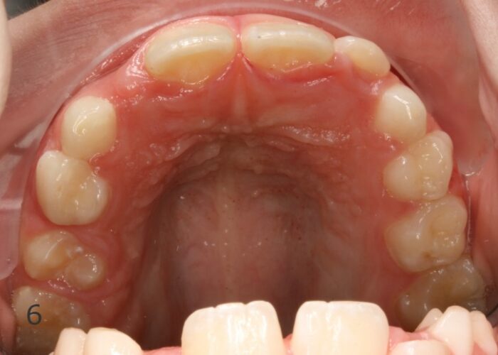 Upper Occlusal-Progress-2008_12_17-0_4 Close-up of the upper dental arch showing crowded, misaligned front teeth and red, inflamed gums (gum inflammation evident).