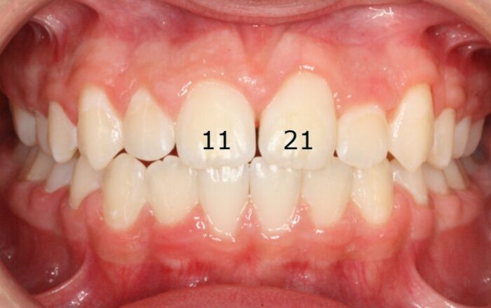 x1191AGG Close-up of upper and lower front teeth with mild crowding and red, inflamed gums.