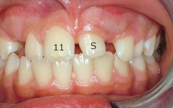 x1193LOD Upper and lower teeth shows supernumerary tooth preventing emergence of left central incisor