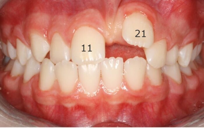 x11985XM Open bite view showing missing upper front teeth and gap in the upper jaw with inflamed gums.