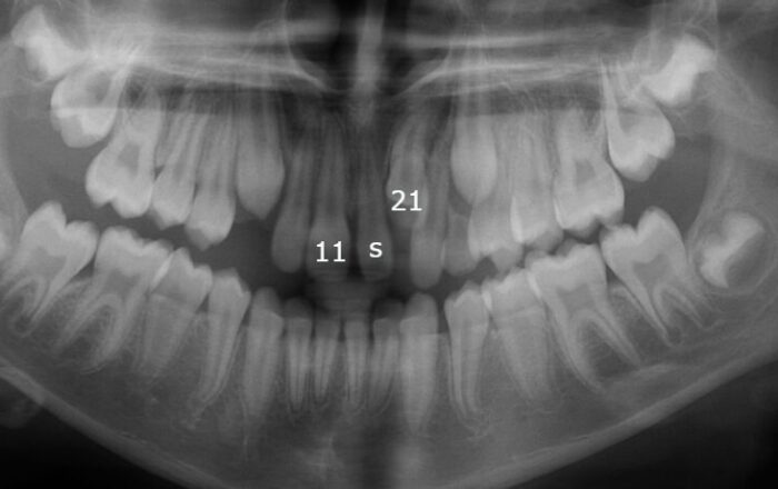 x119MWVK Panoramic dental X-ray of both jaws showing developing and erupted teeth, including wisdom teeth.